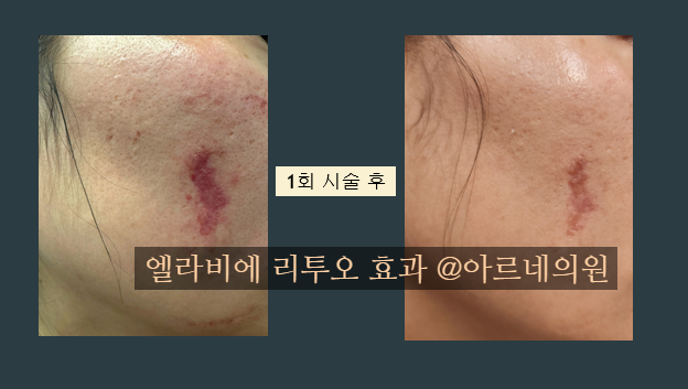  엘라비에 리투오 콜라겐재생효과 후기 아르네의원 원장 직접 작성