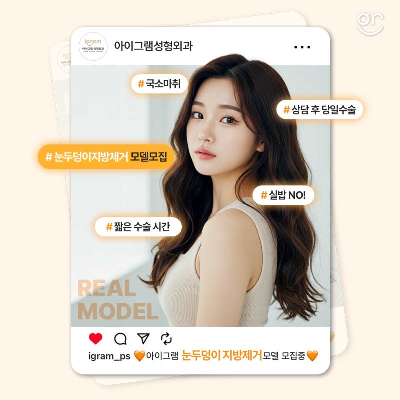 [아이그램성형외과]눈두덩이지방제거 리얼모델 모집