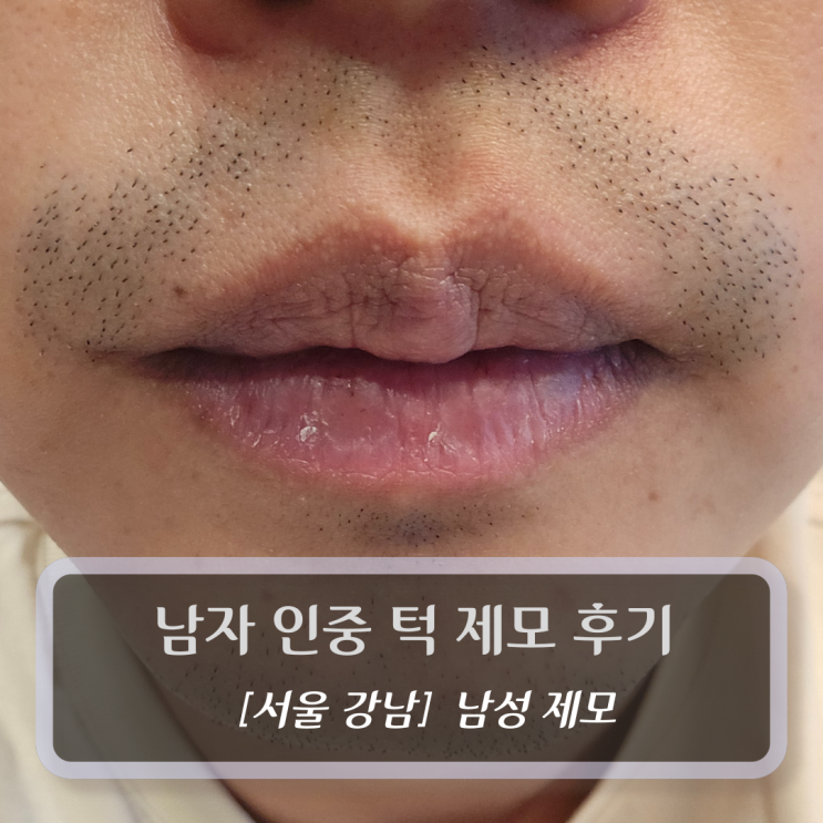 서울 뷰티 :: 강남역 남자 수염 제모 후기