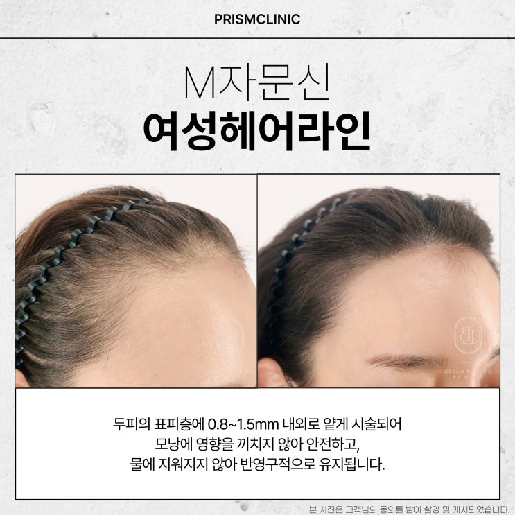  공덕두피문신 탈모 치료, 뭐가 제일 나을까?