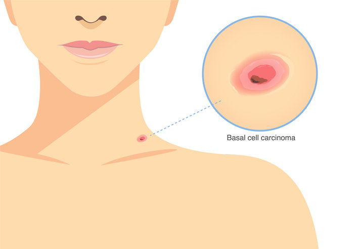 기저세포암 원인 증상 치료 미 대통령 <b>바이든</b>도 걸린 <b>피부암</b>