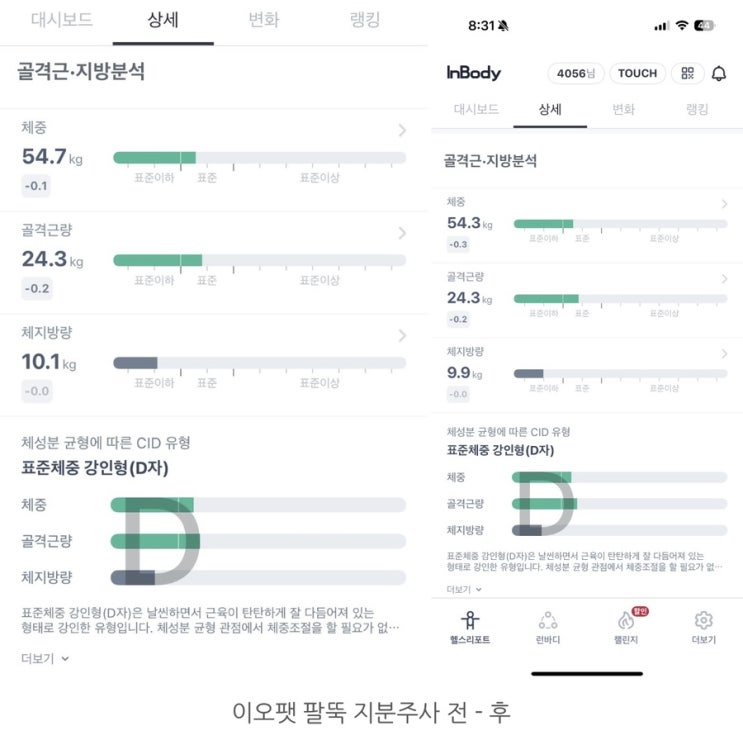  여름몸매관리 이오팻 지분주사 다이어트로 팔뚝살 뿌시기
