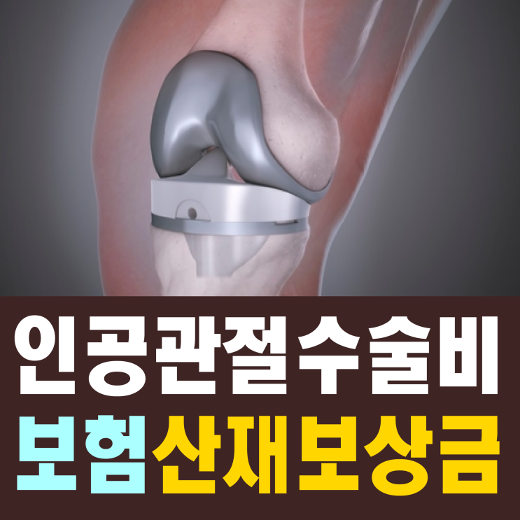 [직업병 무료상담] 인공관절 수술비 보험 중 산재 보상금 받으려면?