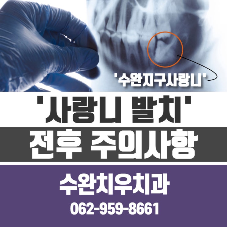  수완지구사랑니 발치 전후 체크 포인트