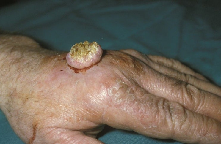 인벌루션(involute) 경향을 가진 잘 분화된 편평 세포 암종(well-differentated squamous cell carcinoma)의 각막아칸소마