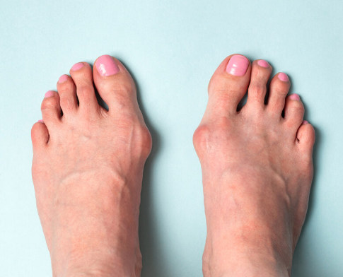  힐 많이 신는 여자 발가락 모양 실화 ? 무지외반증 교정기 통증 증상 개선 효과있을까?