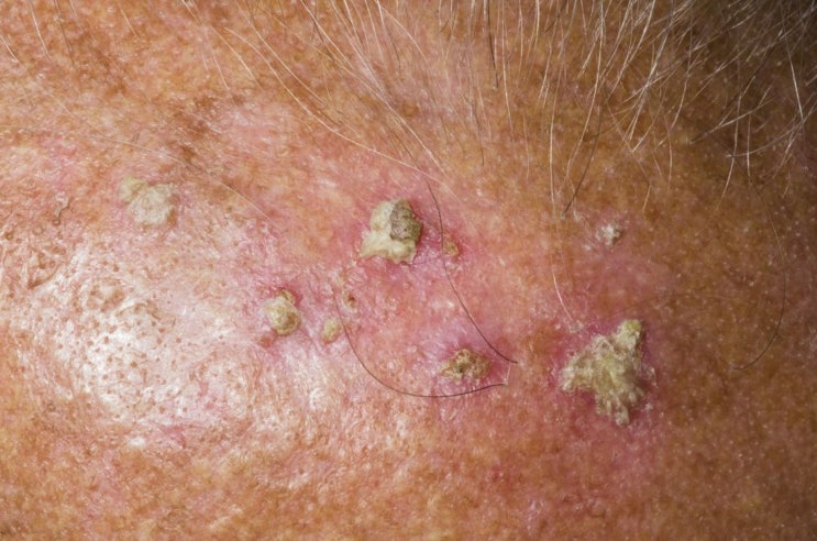 광선 각화증(Actinic Keratosis)