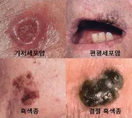 피부암 중 기저세포 암종(Basal cell carcinoma)