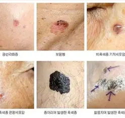흑색종(악성 흑색종)