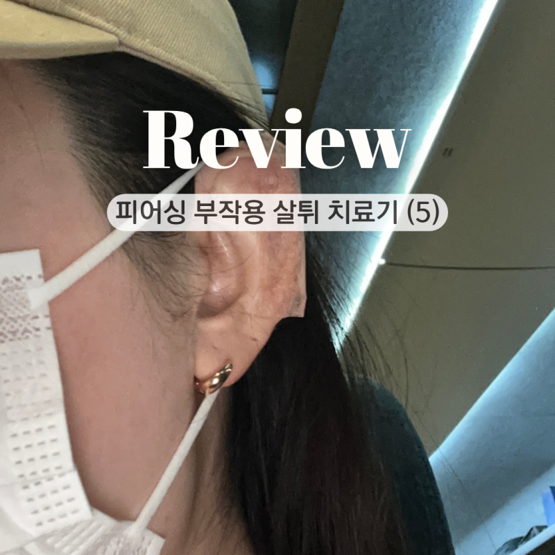 귓바퀴 피어싱 살튀 제거 수술 후기, 통증