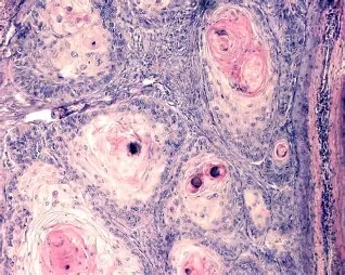 편평세포암(Squamous Cell Carcinoma)과 편평상피세포암이란