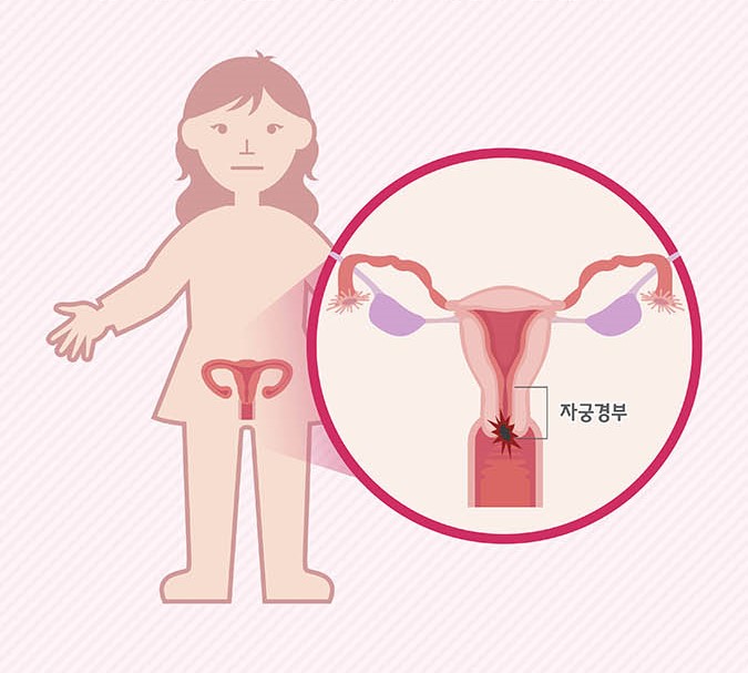  [자궁경부암] 한국인에게 흔한 암 인포그래픽
