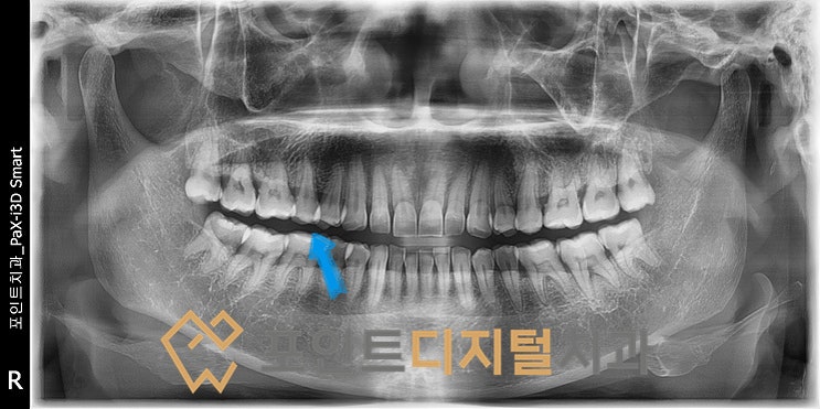  [탕정치과] 식사중 치아파절(발치즉시 임플란트) / 천안 아산