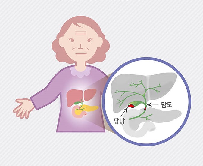  [담낭·담도암] 한국인에게 흔한 암 인포그래픽