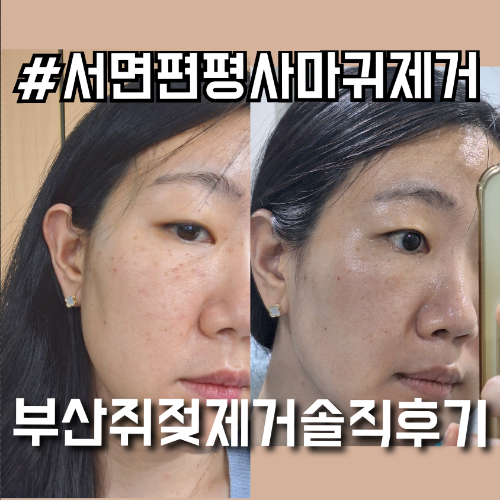 서면편평사마귀제거 한의원 깔끔한 피부 만든 솔직후기