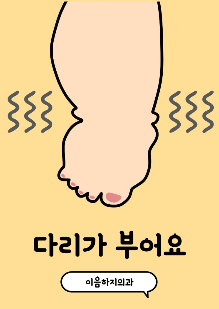  종아리가 부어요 병원에 가야하는 기준