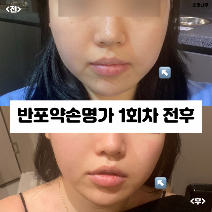  반포약손명가 맞춤관리 작은 얼굴 라인 관리 1회 전후 차이
