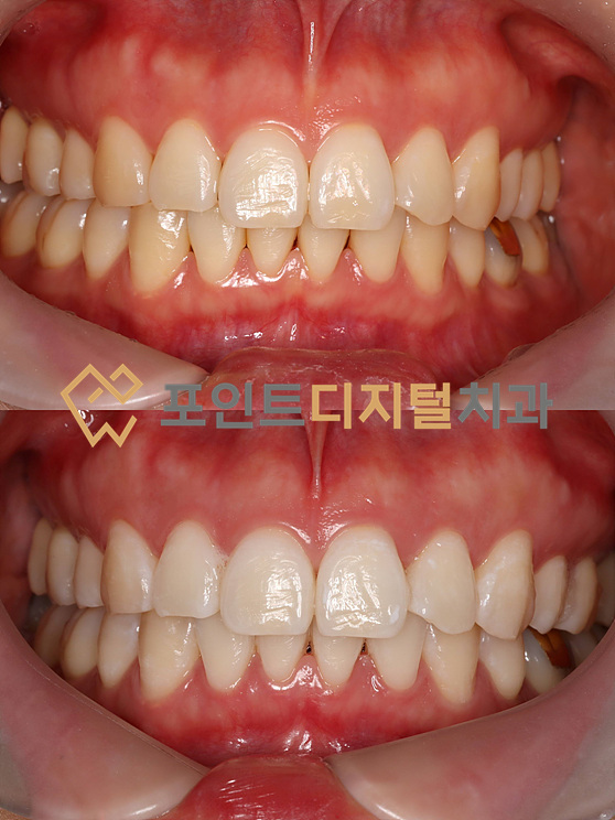  [탕정치과]  원장이 직접 진행하는 오스템 뷰티스 치아 미백 / 천안 아산 불당 배방