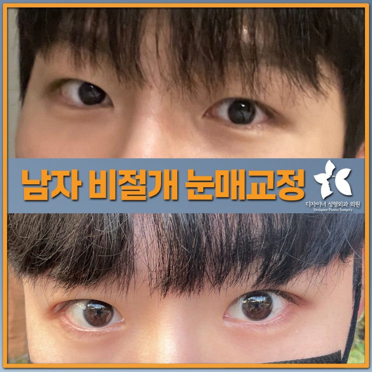  남자비절개눈매교정 자연스럽고 선명한 눈매를 원한다면