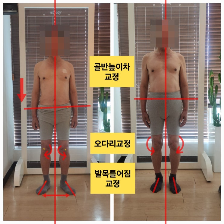  [부산 동래 오다리 교정] 내반슬, 원인은 '이것'부터 시작됩니다.