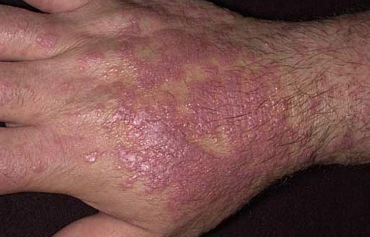 편평 태선(Lichen planus)