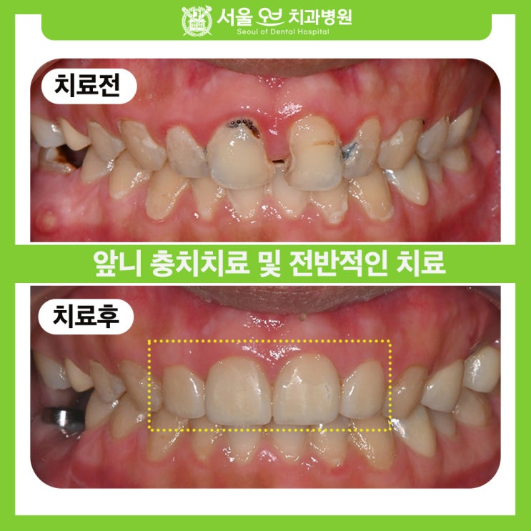  [석촌역치과] 야간·일요일 진료로 완성한 치과 공포증 극복기!