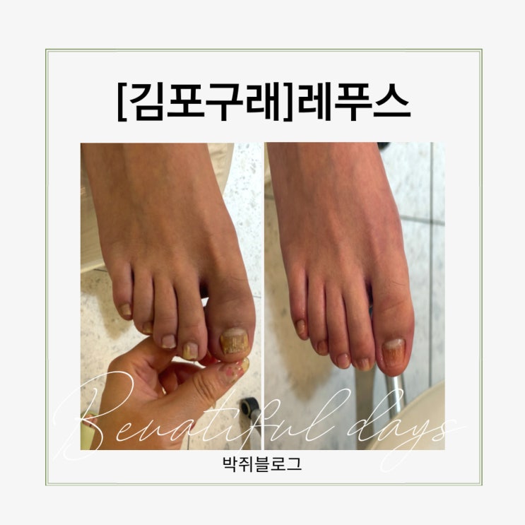  김포무좀 스케일링, 남편 첫 경험 리얼후기 