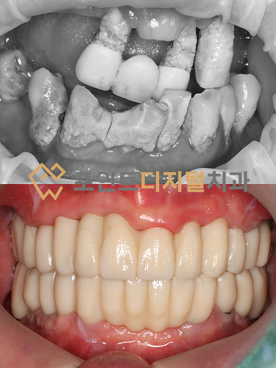  [탕정치과] 어쩌면 한분의 인생스토리가 바뀌는 장면(전악 임플란트) / 천안 아산 불당 배방