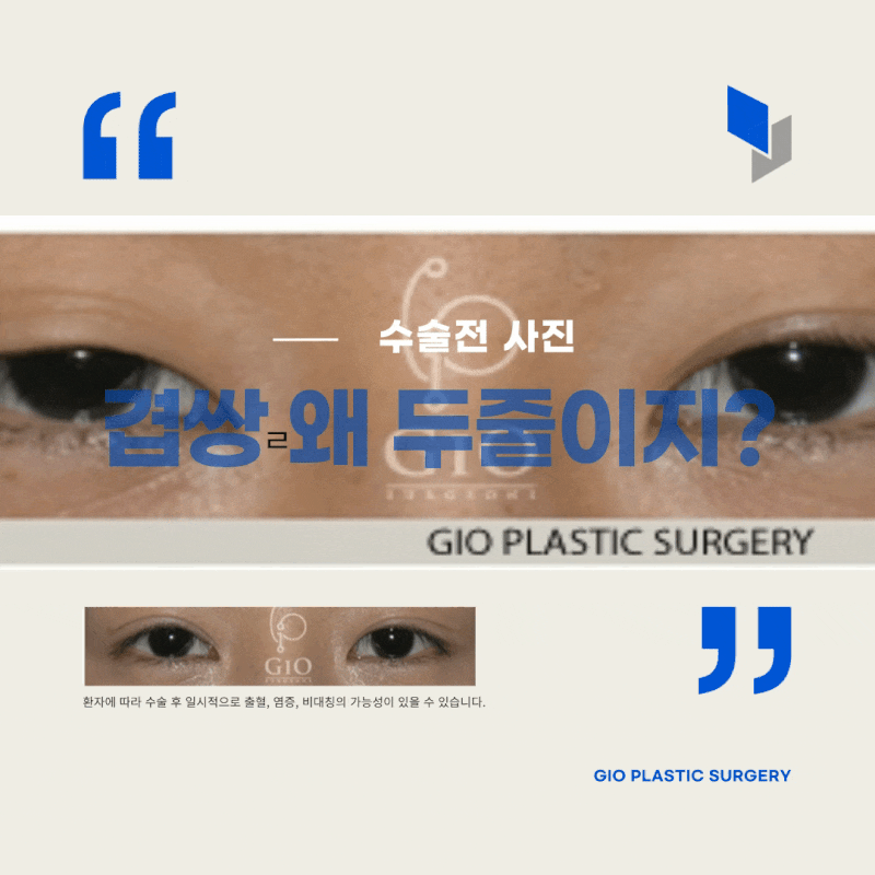 겹쌍 왜 자꾸 두줄 되나, 교정
