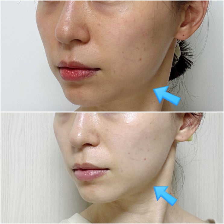  홍대 피부관리 방짜테라피 윤곽관리 작은얼굴 비포 애프터