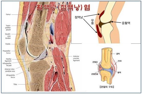 무릎이 아프고 부을때 - 점액낭염 치료, 관리방법
