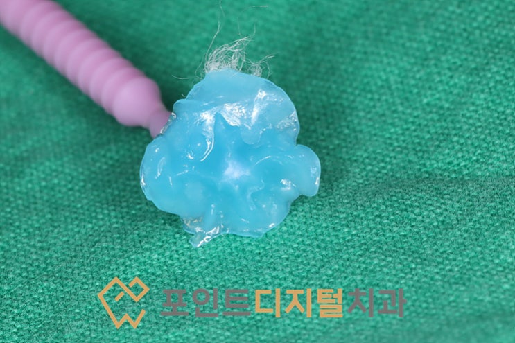  [탕정치과]  스탬프 테크닉을 이용한 레진 케이스 / 천안 아산
