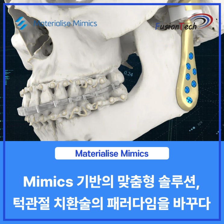  [Materialise S/W] Mimics 기반의 맞춤형 솔루션, 턱관절 치환술의 패러다임을 바꾸다