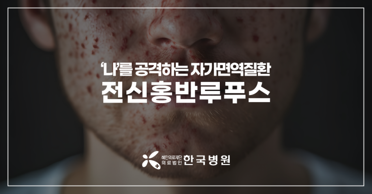  제주 류마티스내과_얼굴에 나비 모양 발진이? 전신홍반루푸스, 증상 광범위해 진단 신중해야