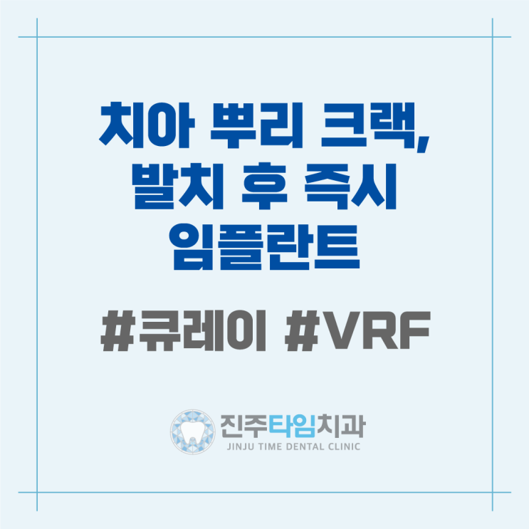  치아 뿌리 크랙, 발치후 즉시 임플란트 #큐레이 #VRF