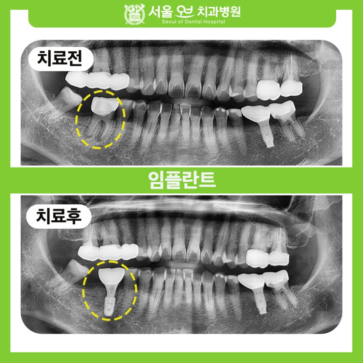  [잠실새내역치과] 보험 임플란트로 부담은 줄이고, 안전은 높인 어금니 치료를!
