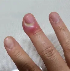  조갑주위염(Paronychia)