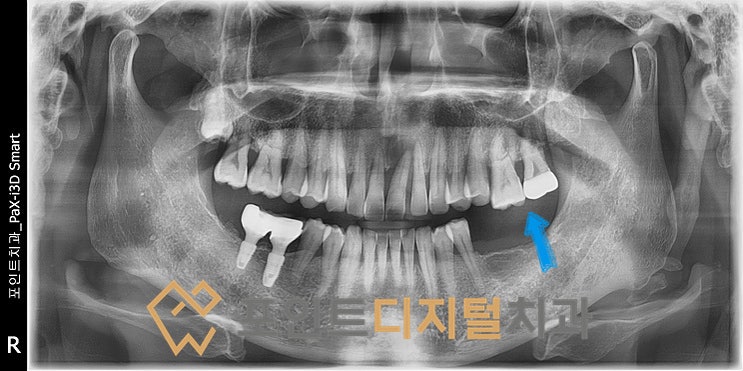  [탕정역임플란트]  치아를 상실하고 치료를 늦추게되면... / 천안 아산