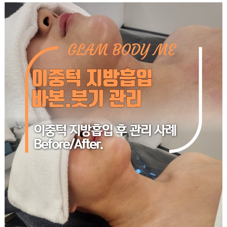  이중턱 지방흡입 바본,붓기 해결! 후관리로 달라진 라인 공개 (2주차~5주차 B&A)