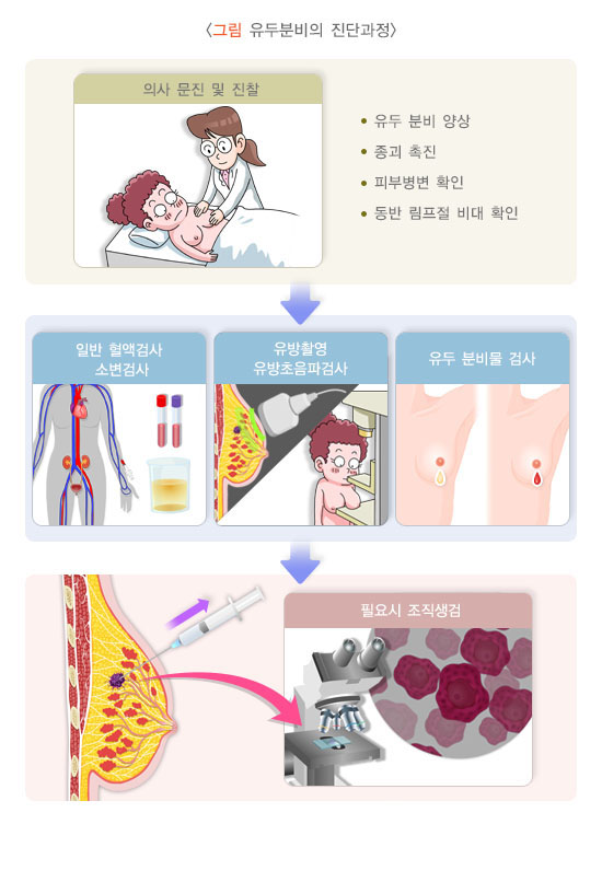 유두 분비물의 원인과 증상 치료