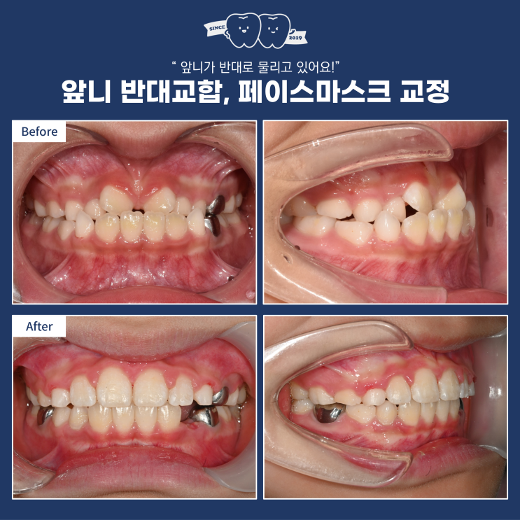 성장기 어린이에서 턱 교정 치료가 필요할 때, 턱 교정의 이미, 페이스 마스크 치료의 효과