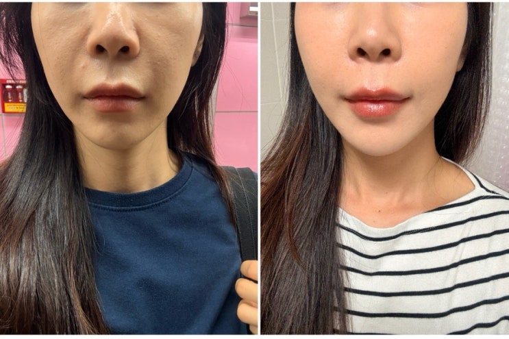  압구정피부과 볼뉴머 리프팅 400샷 내돈내산 전후비교 이번주 일상