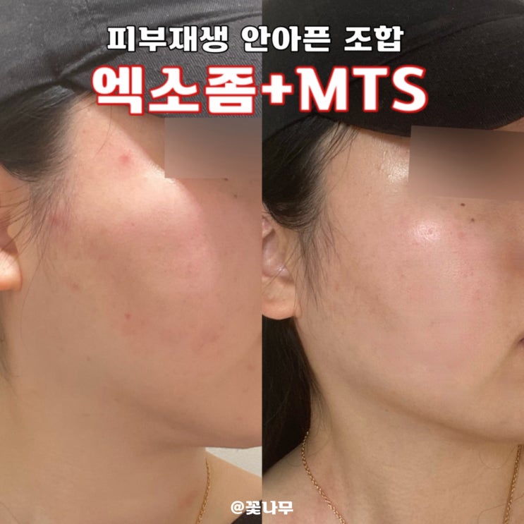  동작구 피부과 흑석역 피부 모공 재생 안아픈 조합 엑소좀 MTS 추천