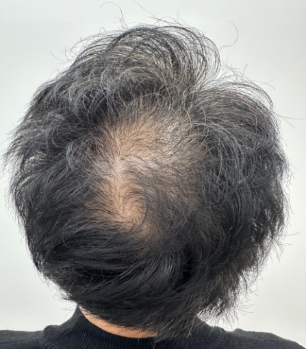 대구남성탈모커버, 가릴수 있는 방법이 있다면?
