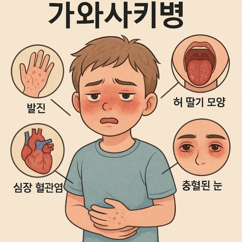 가와사키병 전염 치료기간 증상 재발 된다면?