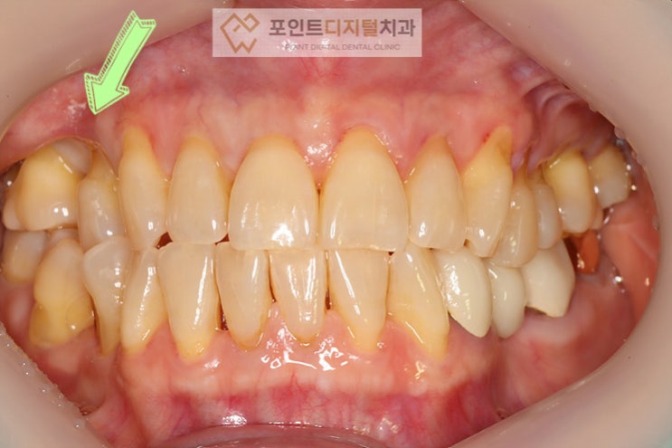  [탕정역치과]  디지털을 이용한 심미보철 / 천안 아산