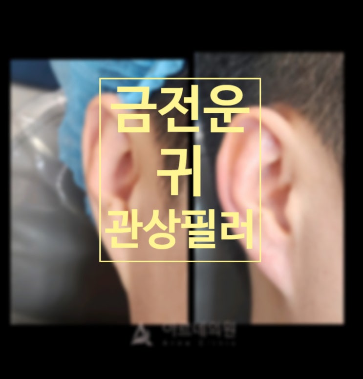  재물운을 올리는 누운 귀 귓볼 교정 필러