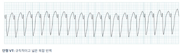 VF(V-fib), VT(V-tach), PEA, asystole - Shockable & Non-shockable rhythm ...