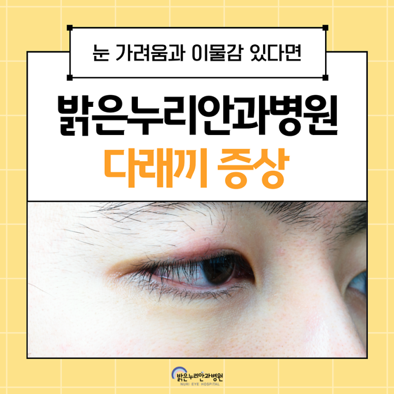 눈다래끼안과 수술이 필요한 증상은?