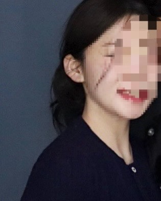 [부산귀필러] 작고 누운귀 필러 찐 후기(귀필러유지)